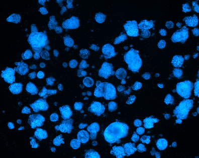 Dr. Hill's lab uses unique patient derived organoid models like these to study ovarian cancer and better understand tumor response to therapy to more effectively treat patients.